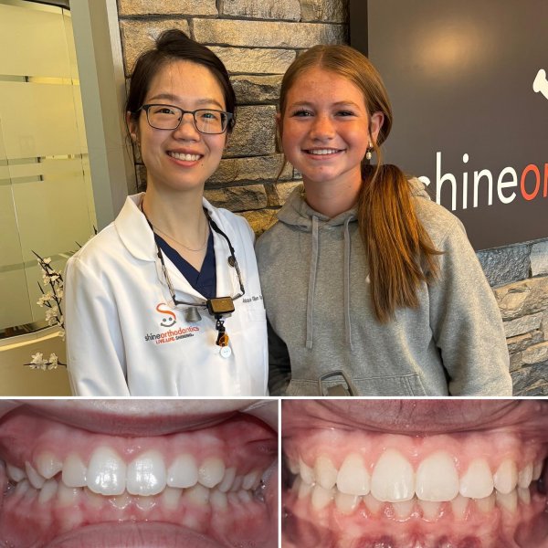 Doctor and Patient smiling and one set of teeth before braces and one set of teeth after braces 