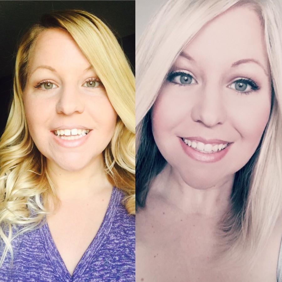 What is Invisalign and How Does It Move Teeth (Part 2)?